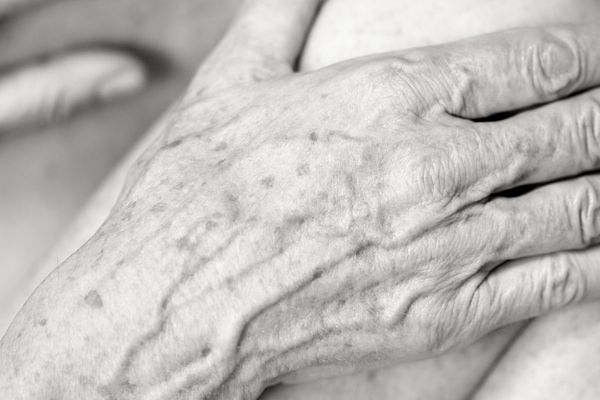 Age Spots removal on the hands by cryosonic Huntingdon