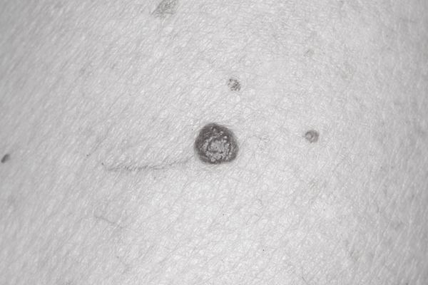 Cherry Angioma Post-Treatment Care for Best Results Huntingdon