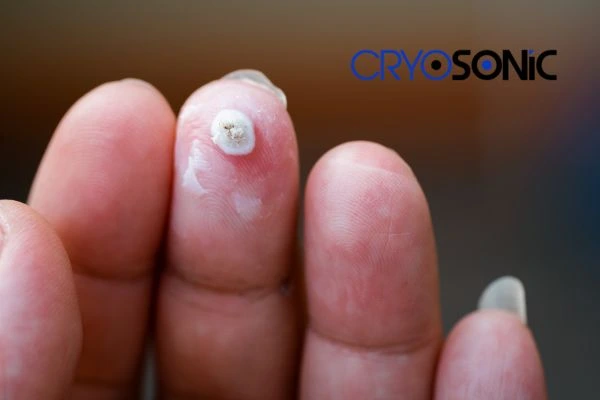 Learn more about us Huntingdon at Cryosonic. Book in today! Huntingdon
