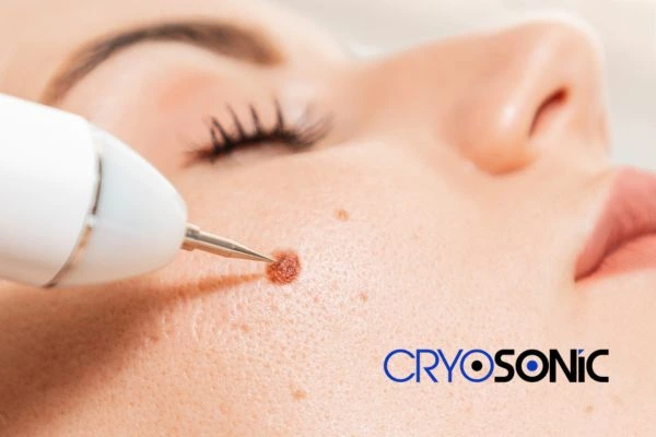 why choose us at Cryosonic for blemish removal? Find out more now Huntingdon