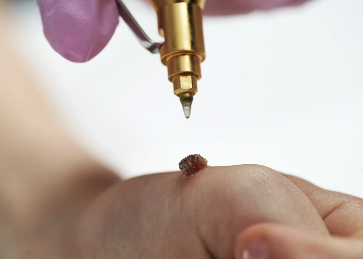 Cryopen For Children Bristol Huntingdon