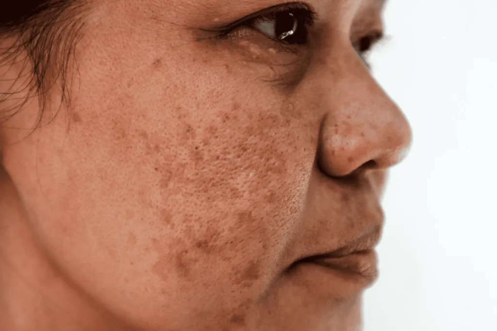 Aftercare Advice for Sun Damage Treatment Huntingdon