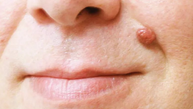 Are There Any Side Effects After removing the Skin Tags? Huntingdon