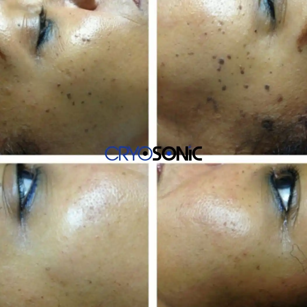 Why Skin Shows Pigmentation After Treatment Huntingdon
