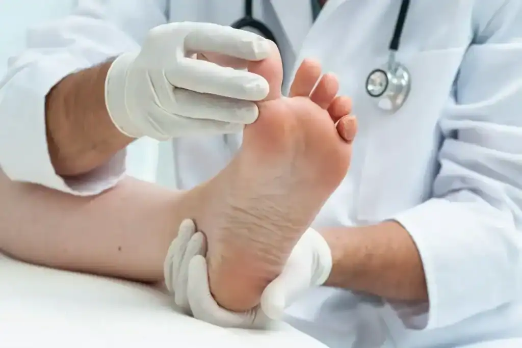 Porokeratosis Removal Treatment Huntingdon